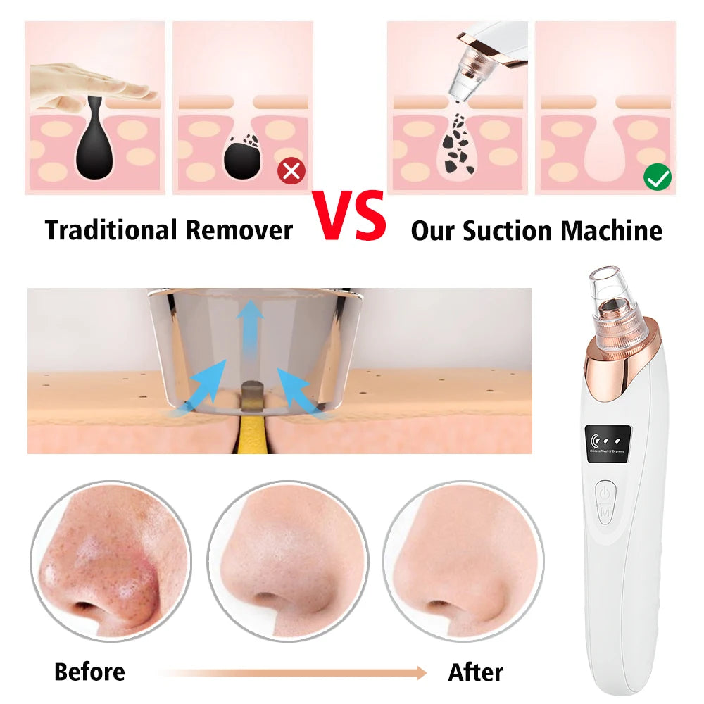 Blackhead Remover & Pore Cleaner Black Pimple Blemish Remover