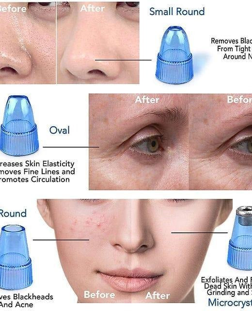Derma suction Blackhead Remover Vacuum Acne Cleaner Black Spots Removal