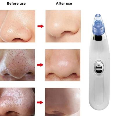 Derma suction Blackhead Remover Vacuum Acne Cleaner Black Spots Removal