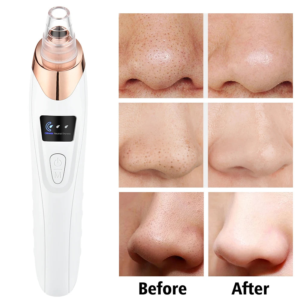 Blackhead Remover & Pore Cleaner Black Pimple Blemish Remover